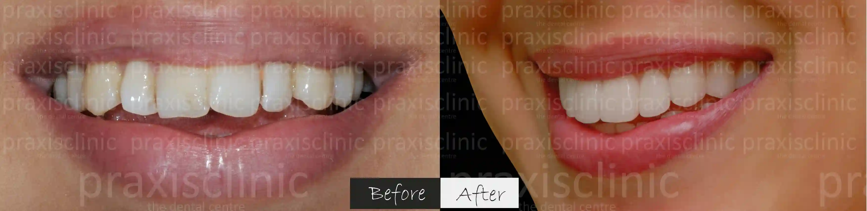 Before and After results of Smile Makeover at Praxis Dental clinic in Mumbai
